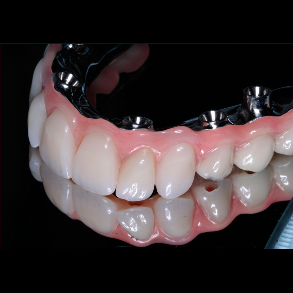 Full-arch case by Unident Art Dental Lab